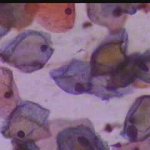 Τυπική κοιλοκυττάρωση